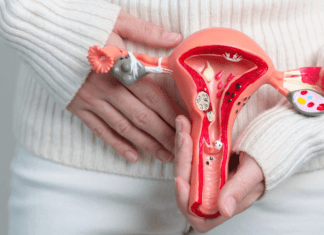 Endometriosis, no tiene cura, pero sus síntomas se pueden tratar