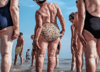 Displasia de cadera en adultos