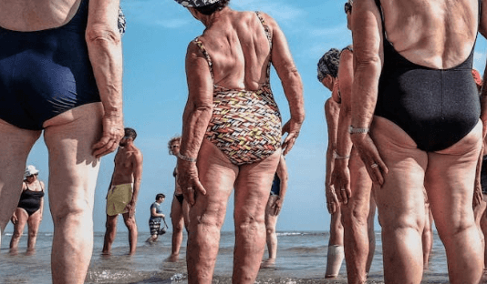 Displasia de cadera en personas adultas